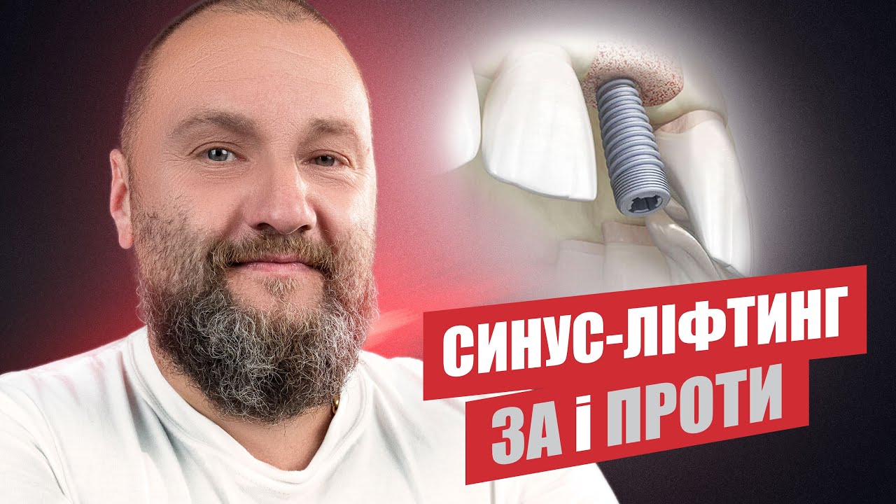 🇺🇦 Синус-лифтинг, стоит ли делать?