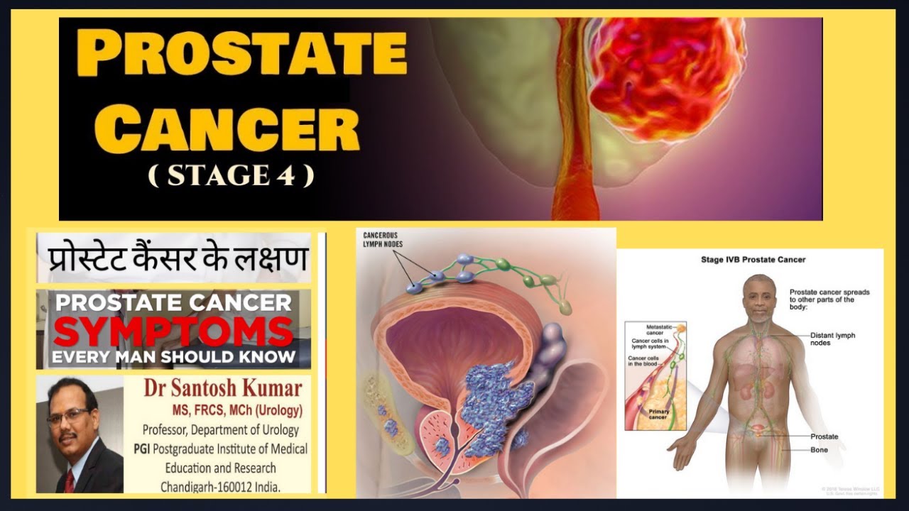 Prostate Cancer| Stage 4 Prostate Cancer |Metastatic Prostate Cancer|  Dr.(Prof)Santosh Kumar PGI.