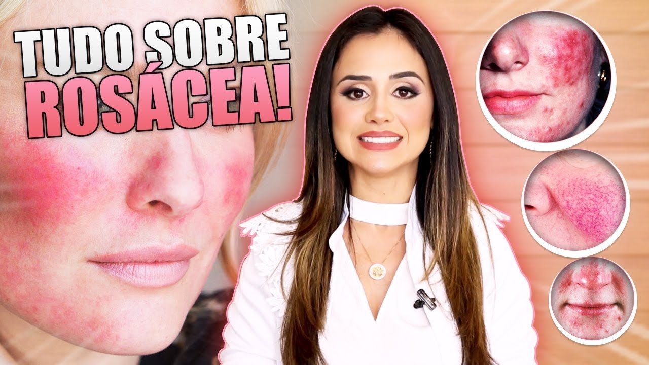 ROSÁCEA: 6 DICAS CASEIRAS MATADORAS PRA VOCÊ CUIDAR DA PELE COM ROSÁCEA POR DRA JOYCE RODRIGUES