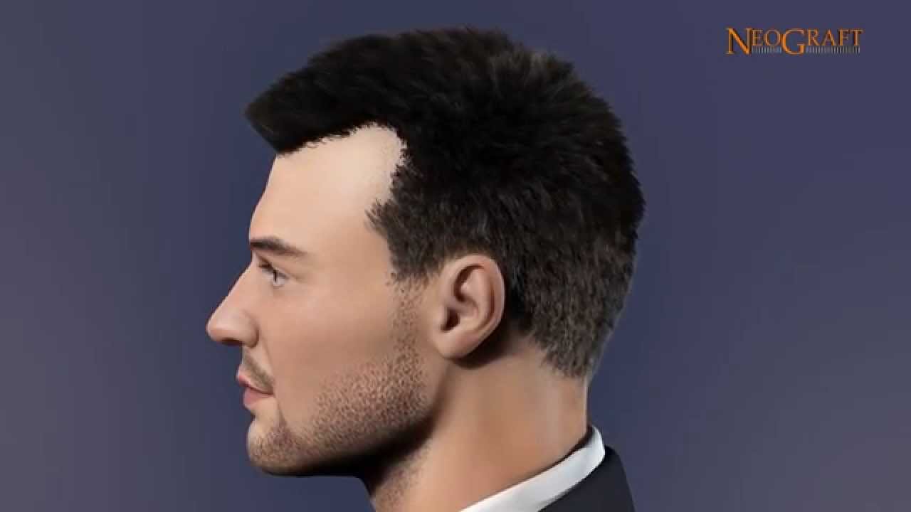 NeoGraft Hair Transplant System Explained  Follicular Unit Extraction FUE