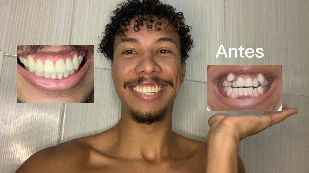 ANTES X DEPOIS DOS MEUS DENTES 🦷 