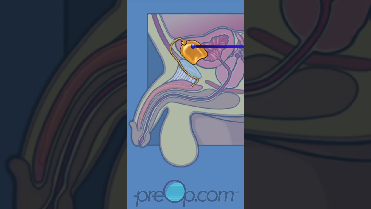 🔍 PreOp&reg; Inflatable Penis Implant Patient Ed 💡Master Key Steps Quickly✨ #shorts