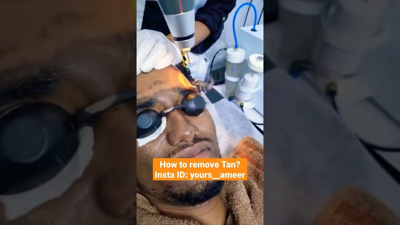 Wow...TAN Removal Laser treatment ❣️❣️❣️ #ameerht