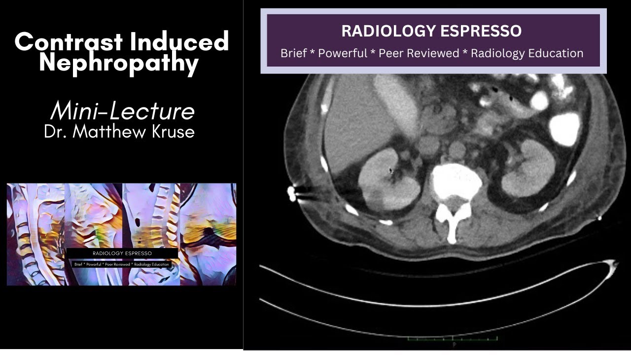 CONTRAST INDUCED NEPHROPATHY: Mini Lecture, Dr. Matthew Kruse