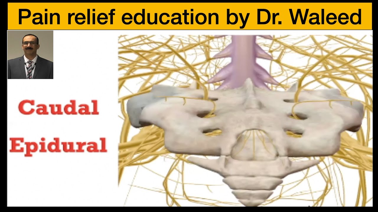 Как провести каудальную эпидуральную анестезию под контролем флюороскопии или ультразвука?