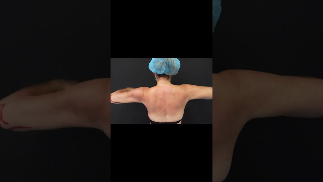 Celebrity Arms&trade; Liposuction | Immediate Results | Expert Dr. Thomas Su | Artlipo