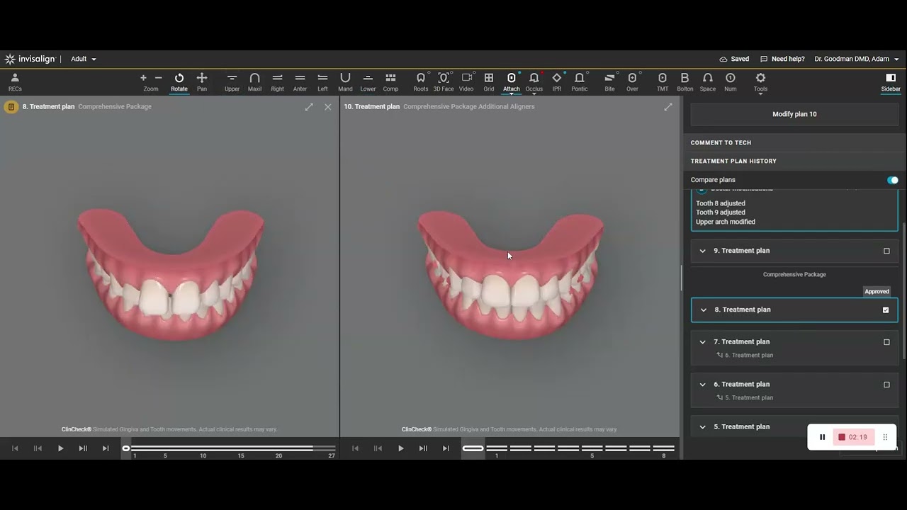 An Easy Invisalign Strategy to Reduce Overjet and Align the Lower Midline in a Class II Subdivision