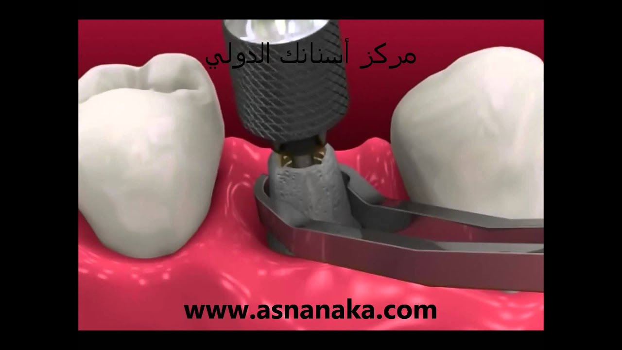 أنواع زراعة الأسنان وكيفية تركيبها وكيفية صناعة تعويضاتها في المختبر