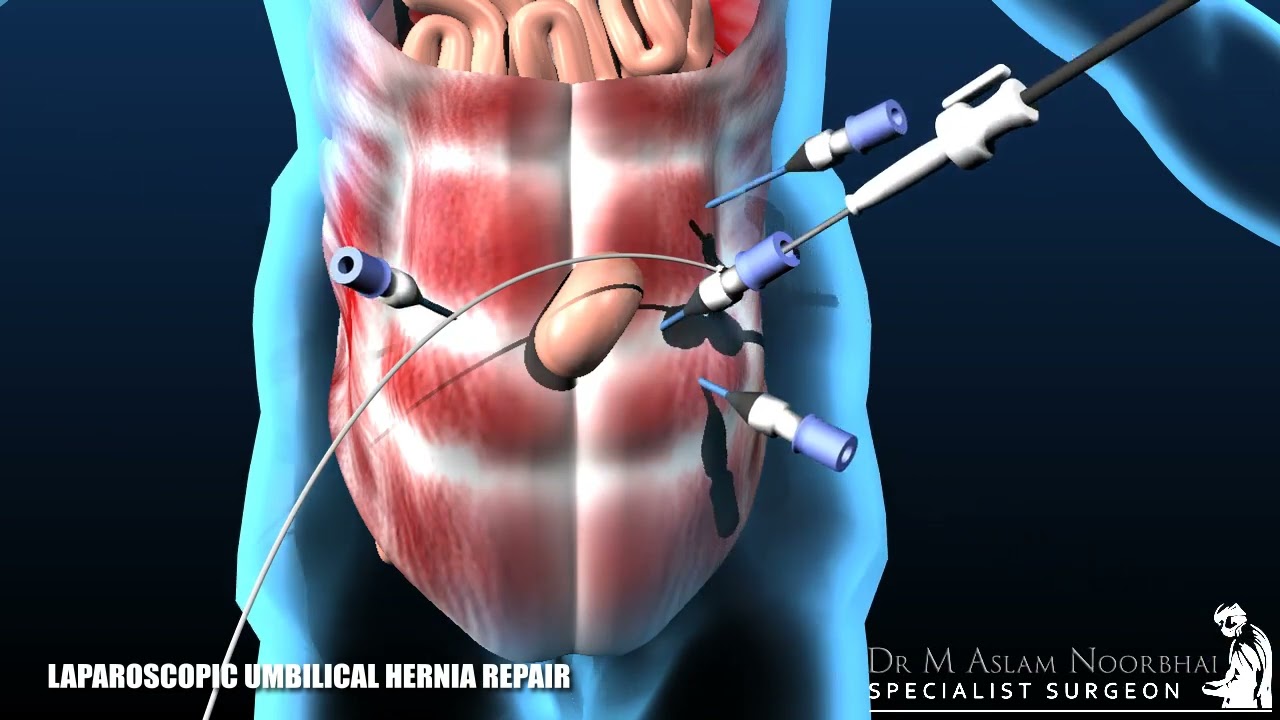 Hernia surgery: Laparoscopic umbilical / incisional hernia repair