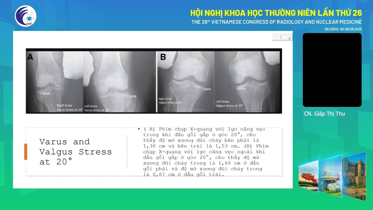 5. Kỹ thuật chụp X quang khớp gối tư thế chịu lực - đánh giá dây chằng chéo sau (CN. Giáp Thị Thu)