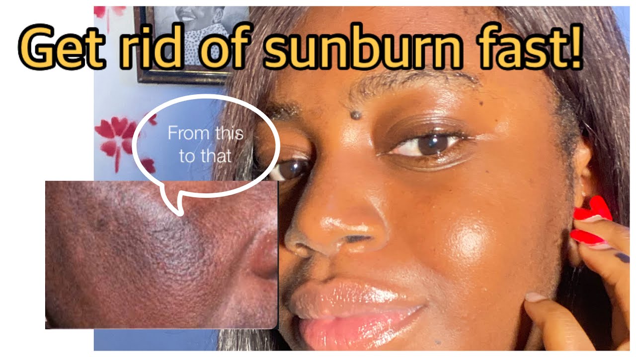 Get Rid Of sunburn Fast ||Best sunburn remedy