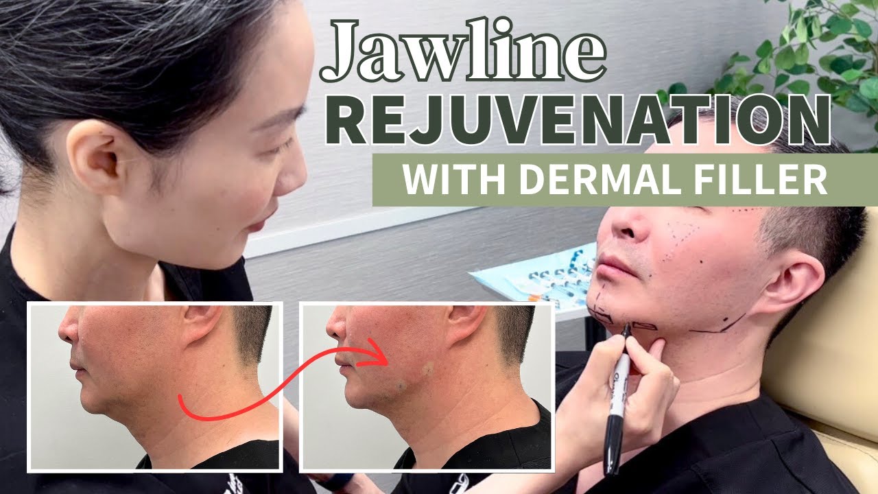 Revolutionize Your Jawline with Juvéderm Volux XC!