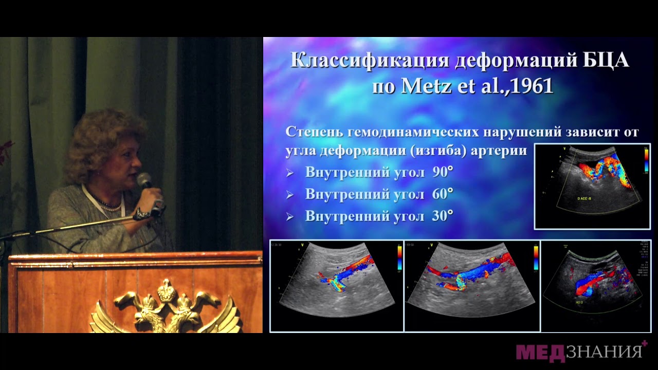 01 Патологическая извитость внутренних сонных артерий как одна из причин сосудистых повреждений нерв