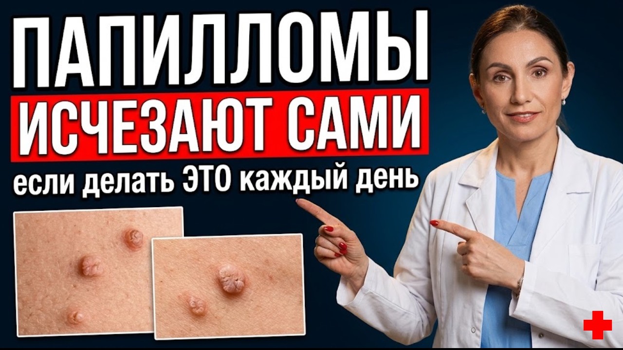 Папилломы и бородавки исчезают сами &mdash; врач объясняет почему они растут и как остановить
