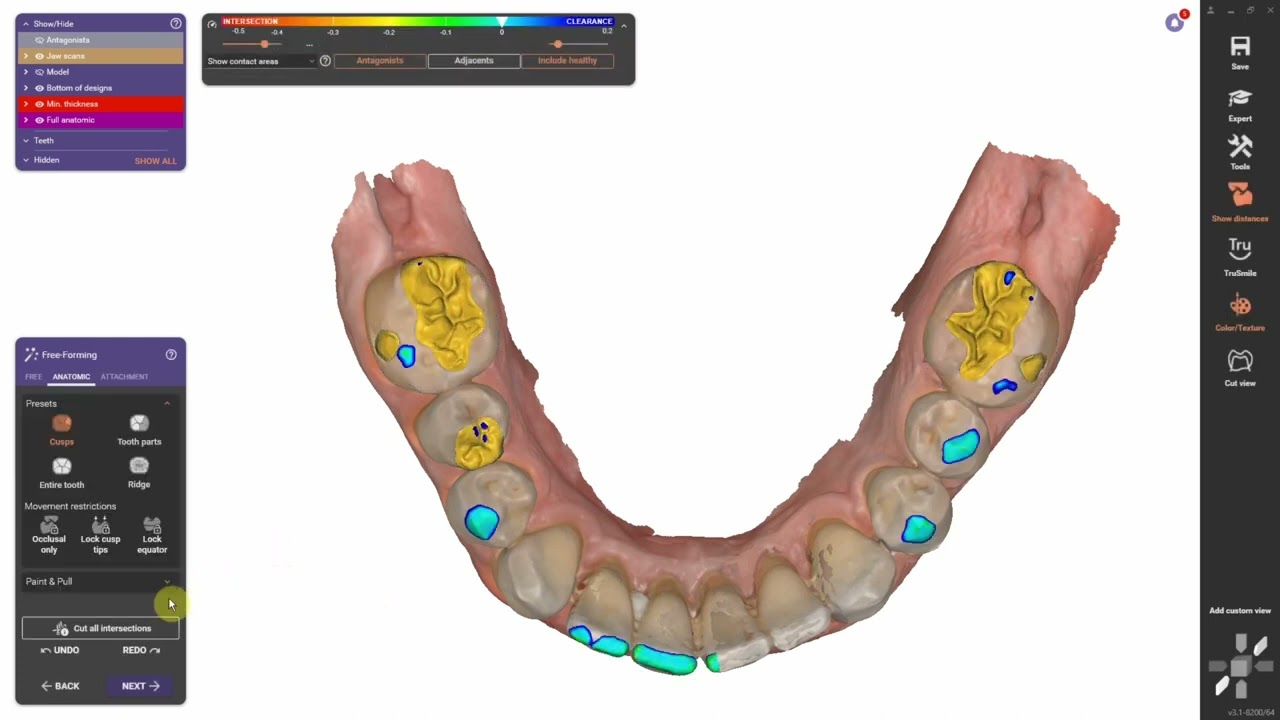3D Printed Restorations!
