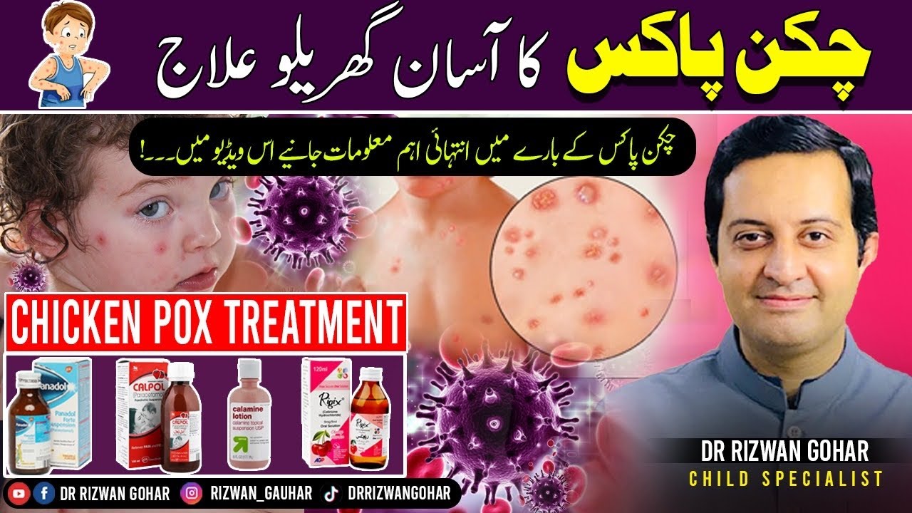 Effective chicken pox treatment🦠🤒: What you need to know #chickenpox #treatment