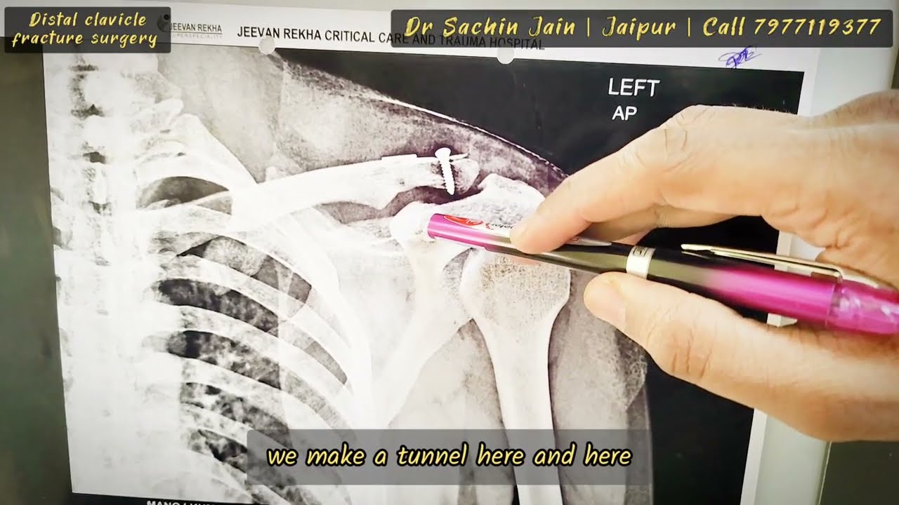 Distal clavicle fracture surgery, Advanced treatment with no plate. Completely Satisfied patient