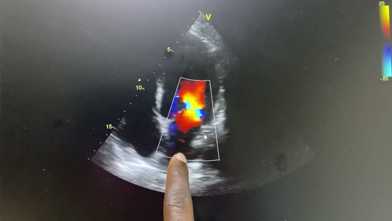Basics of Colour Doppler: MR