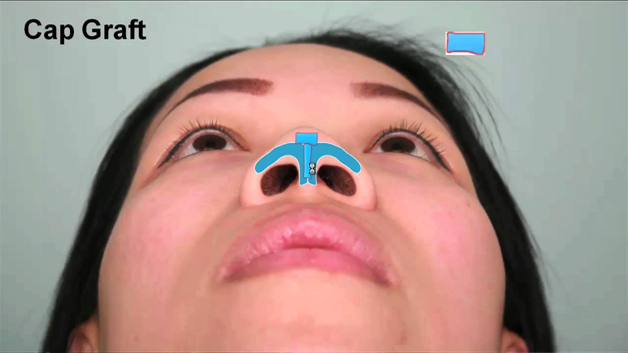Asian Rhinoplasty Tip Augmentation Case Study Part 2 |  Dr. Thomas Buonassisi, 8 West Clinic in BC