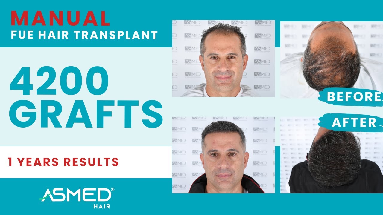 ASMED – Dr. Koray Erdogan – 4200 Grafts | 1 Years Results