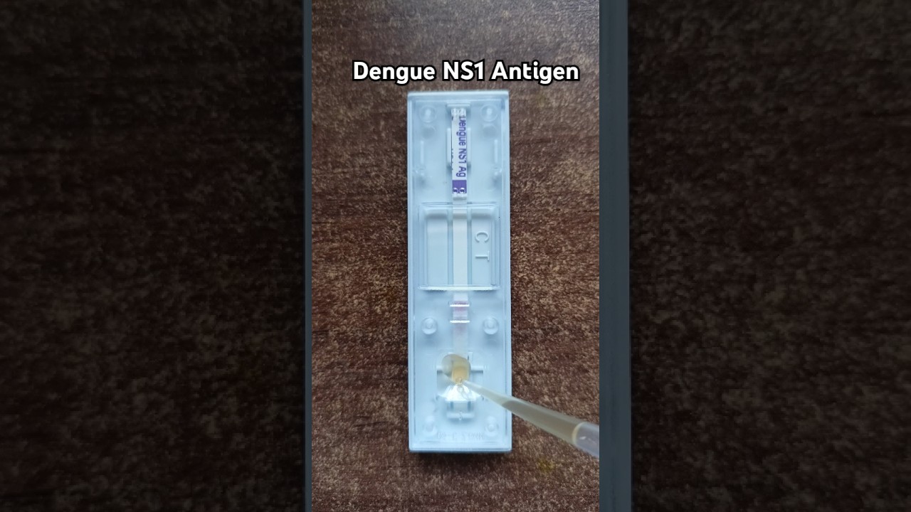 Dengue NS1 Ag kit testing #dengue #ns1 #denguefeversymptoms #medicallab #medicalcollege