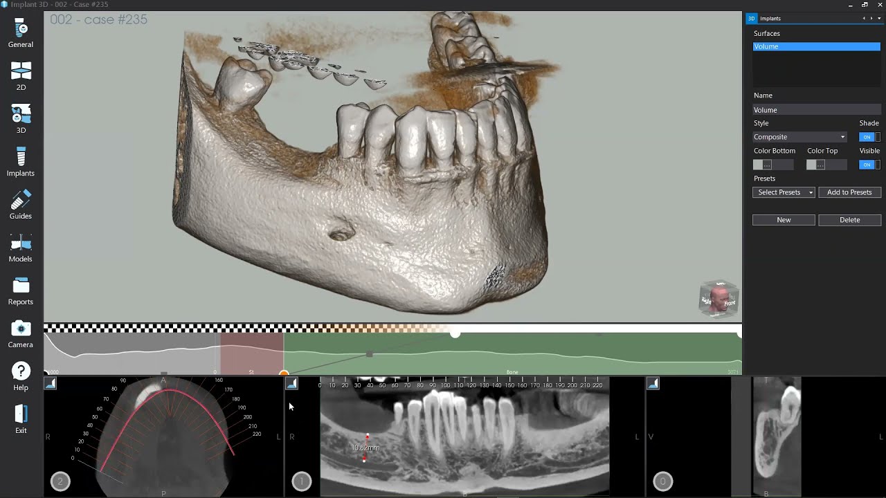 Webinar Implant 3D - Nuova Rel. 9.3