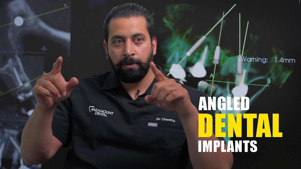 Dental implant placed at an angle | Explained | Roseville CA