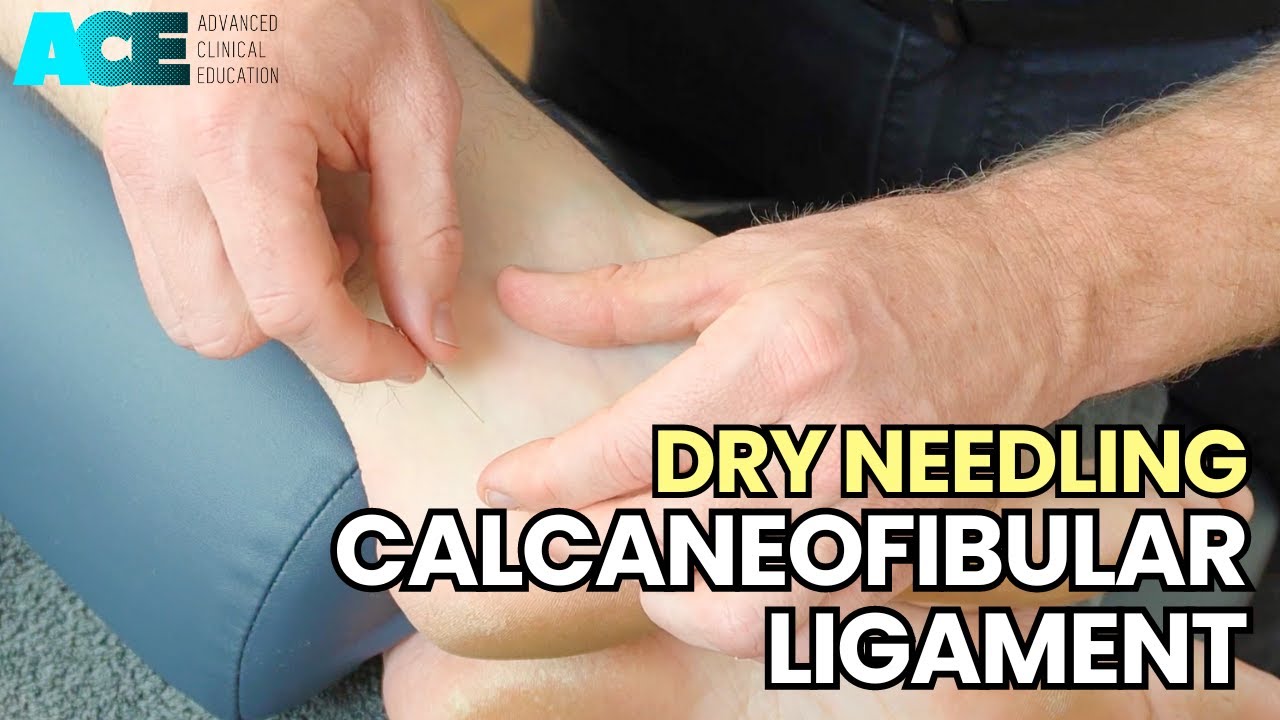 Dry Needling: Calcaneofibular Ligament (CFL)
