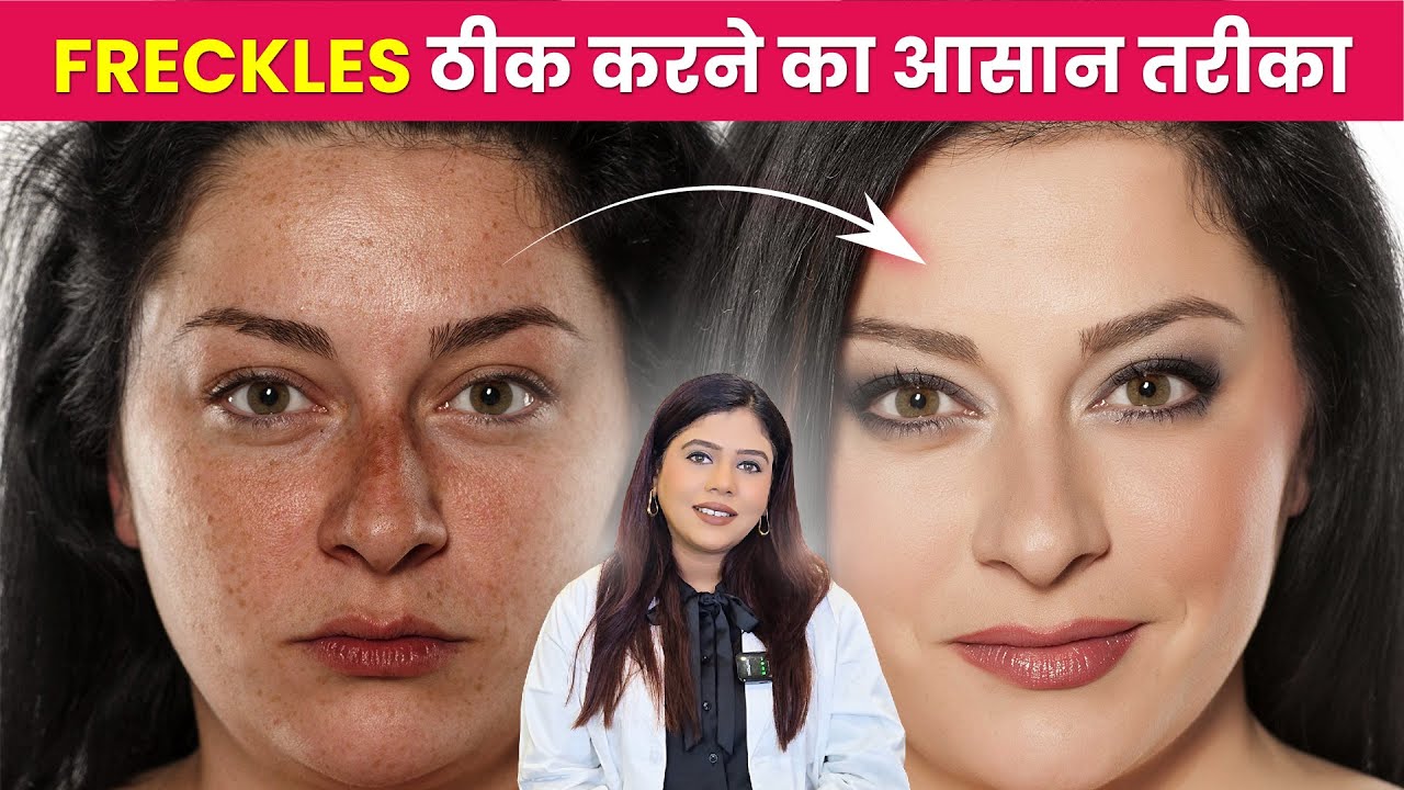 Freckles Kyun hota hai | HOW TO FADE FRECKLES | Dermatologist