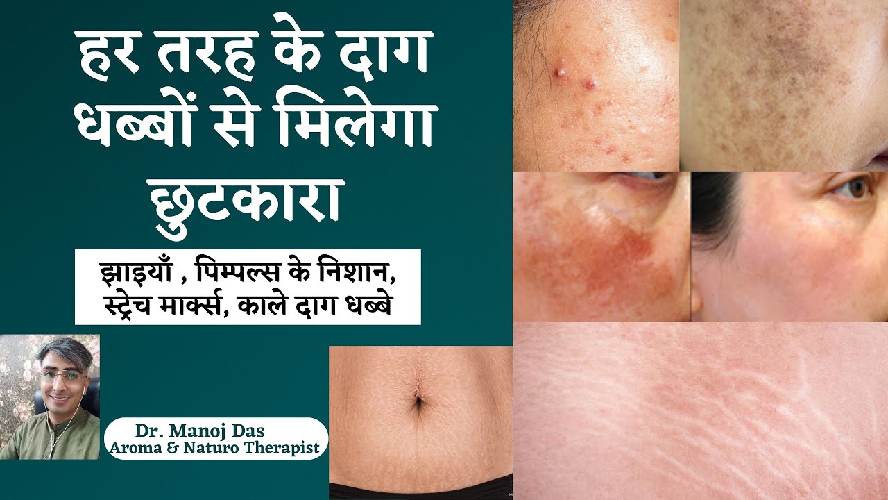 हर तरह के दाग धब्बों से मिलेगा छुटकारा I HOW TO CURE PIGMENTATION I STRECH MARKS I DR. MANOJ DAS