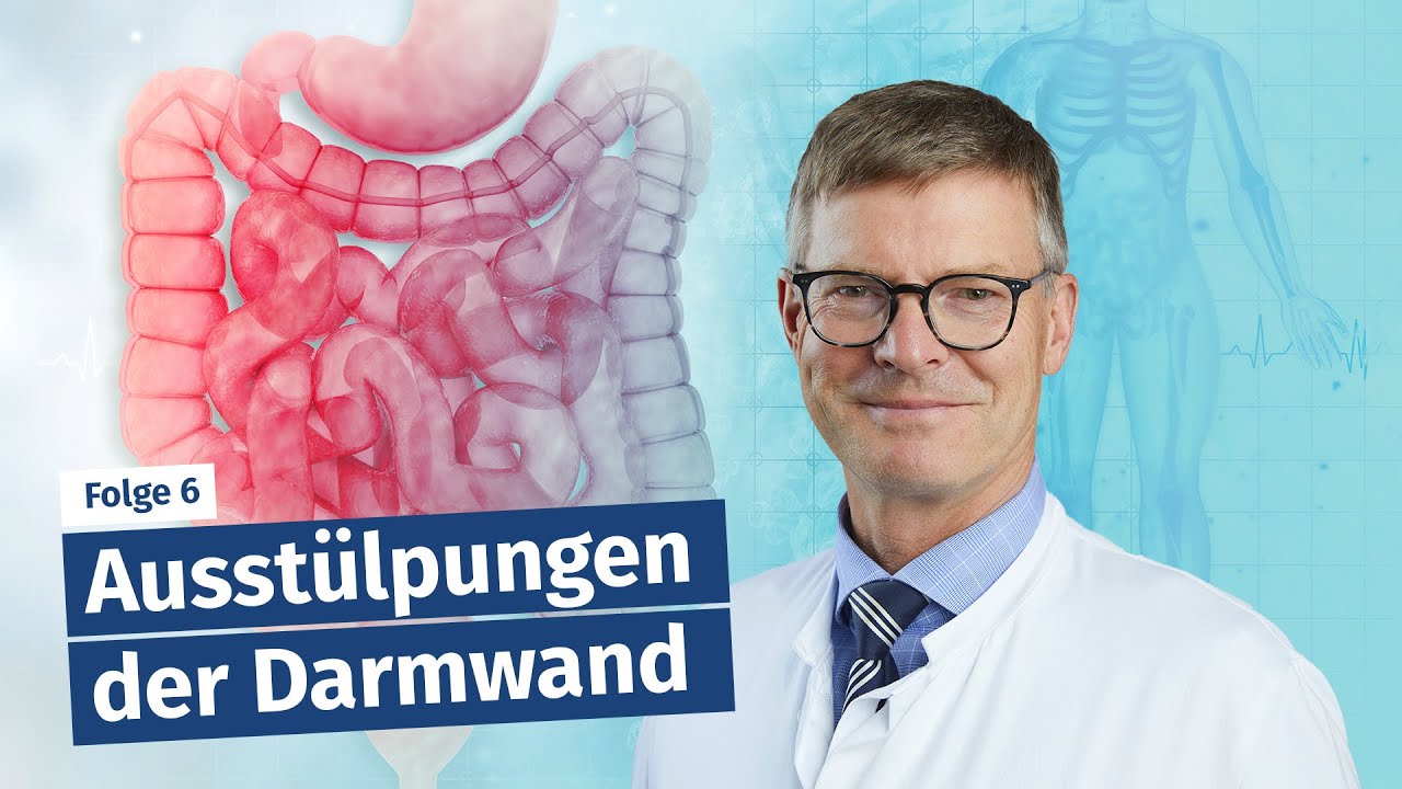 Ausstülpungen der Darmwand - Sigmadivertikulitis