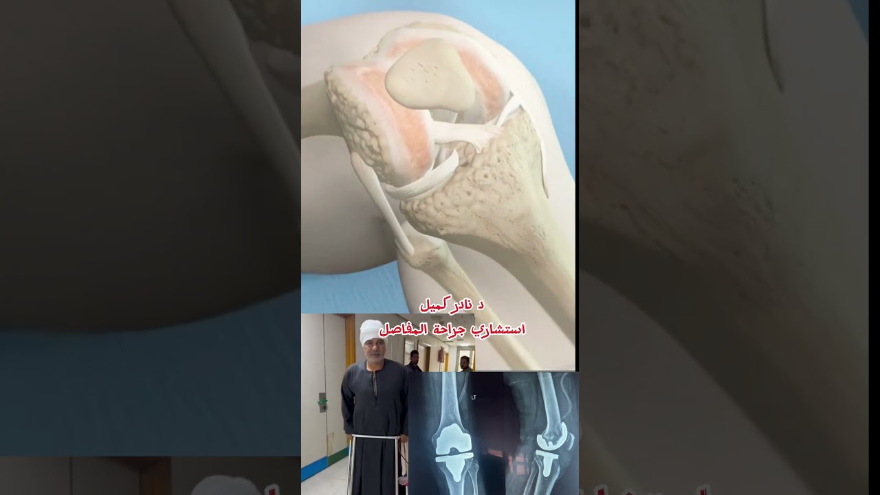 تغيير مفصل الركبة و تركيب مفصل صناعي #دكتور_نادر_كميل #خشونة_الركبة #مفصل_صناعي