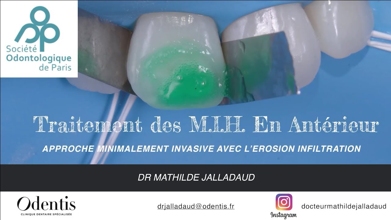 « Traitement des MIH en antérieur » par Mathilde Jalladaud