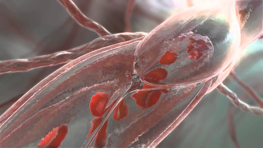 The Role of the C1-Esterase Inhibitor in HAE