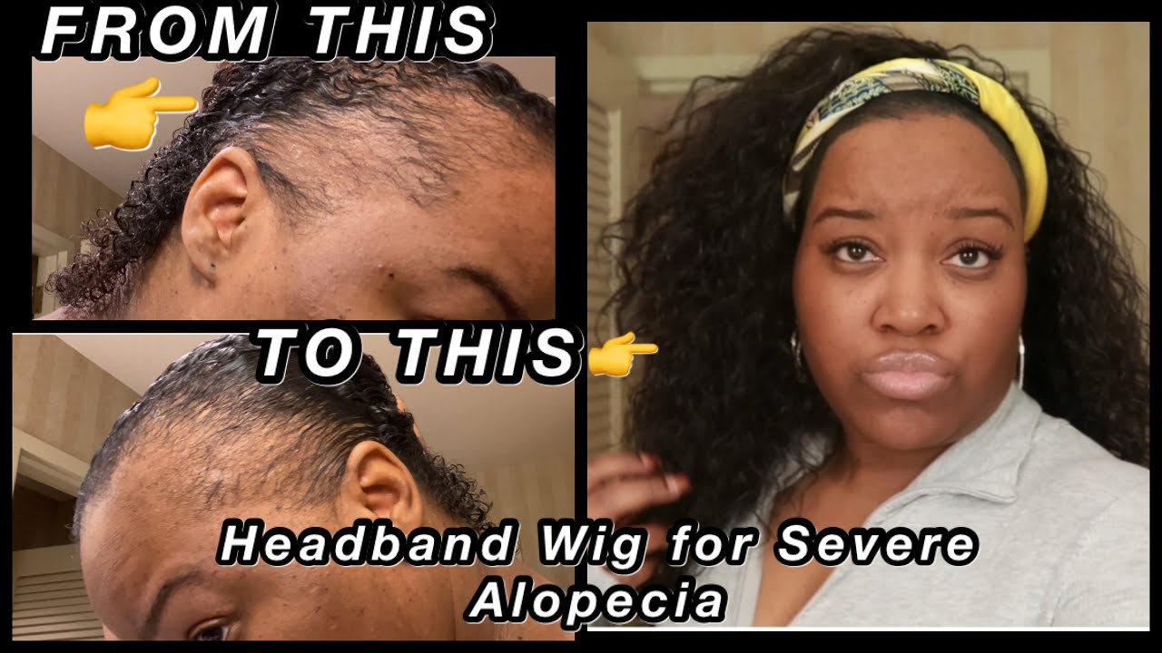 Quick PROTECTIVE Style for SEVERE ALOPECIA | HEADBAND WIG| Instant Edges