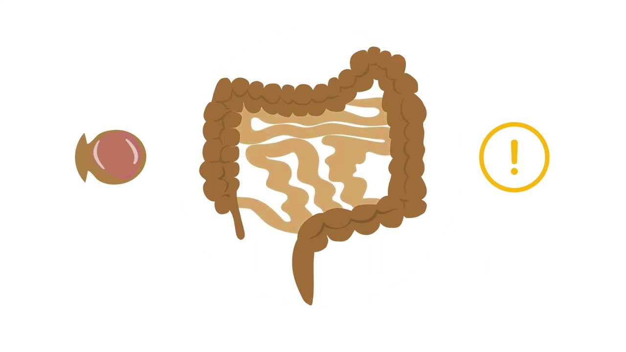 Detecting diverticulitis on abdominal CT