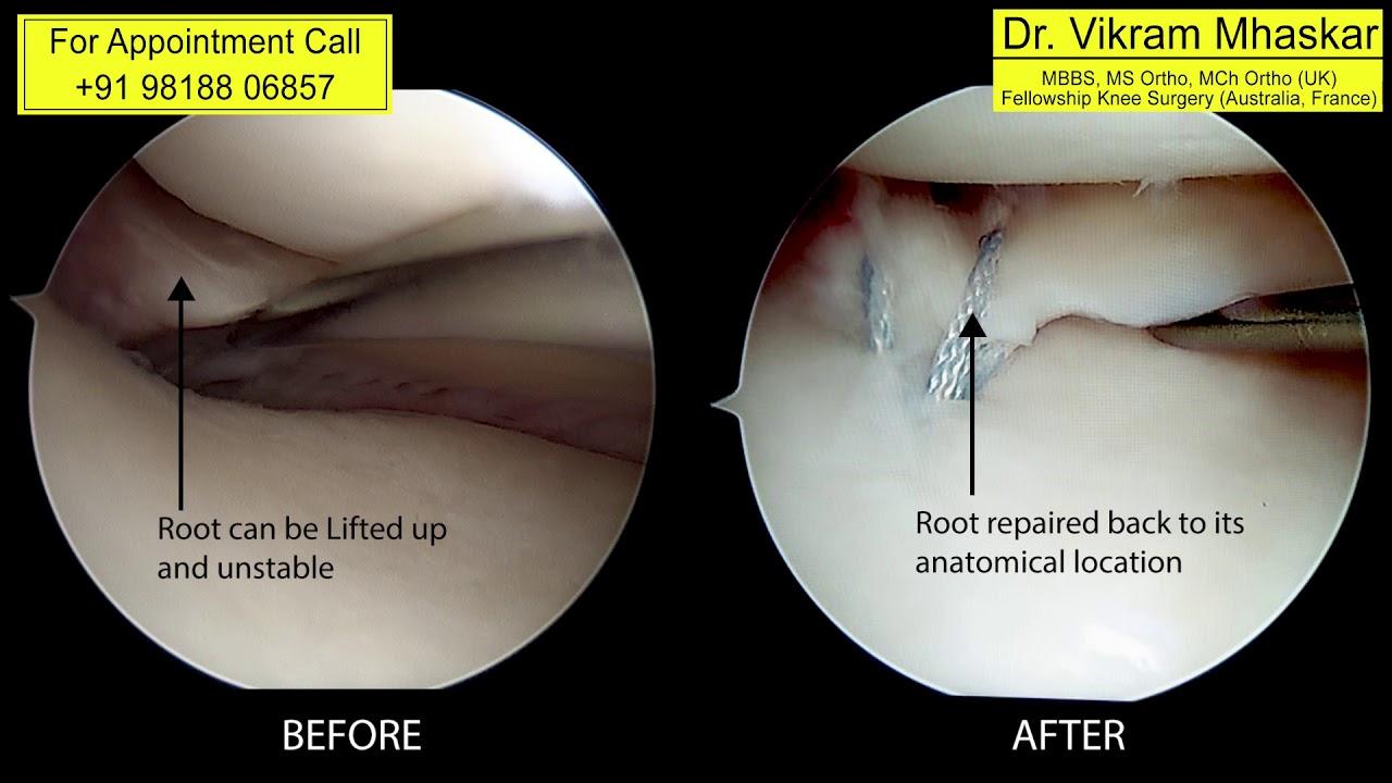 Meniscus Root Repair to Winning the open jujitsu championship in 6 weeks: A journey
