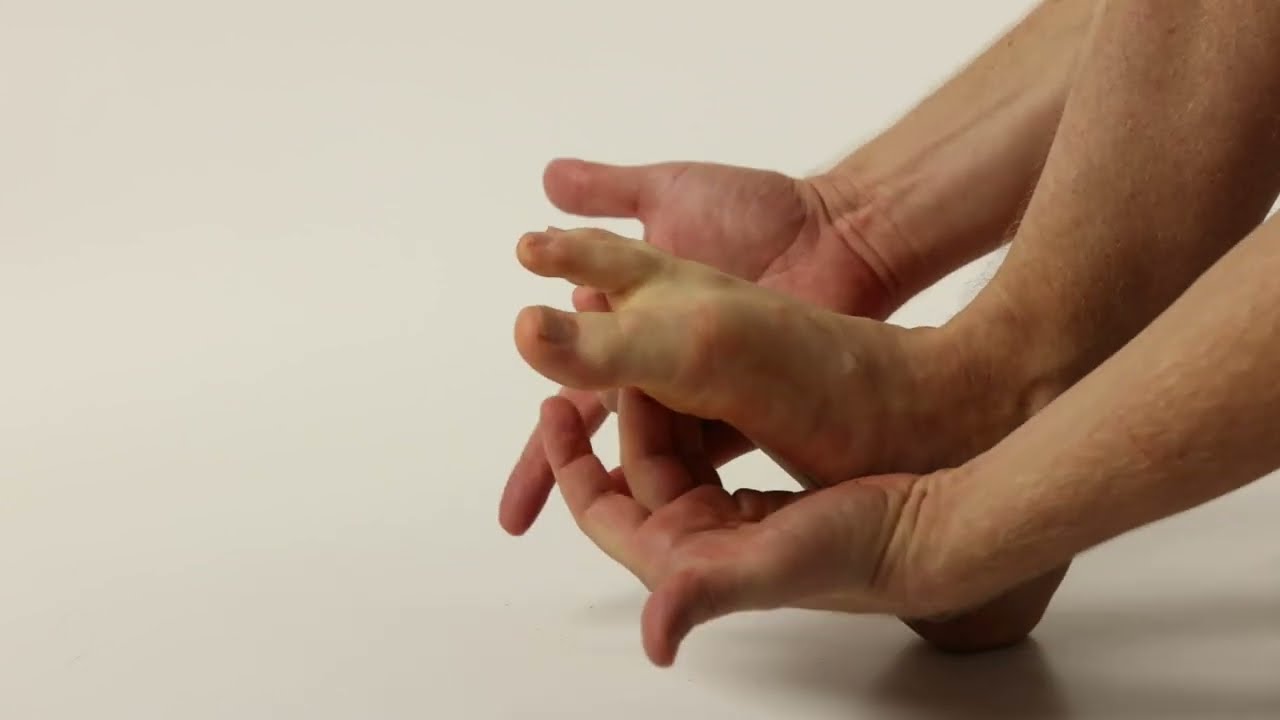 Flat feet: A textbook exercise for the arch