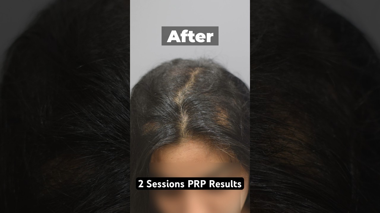 PRP Results Before & After 2 Sessions  #prptreatment #hairlosstreatment