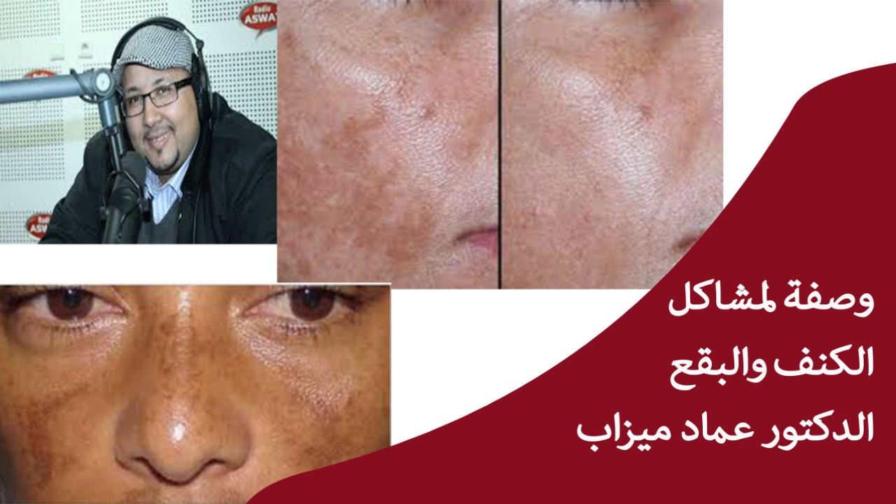 وصفة لمشاكل الكنف والبقع الدكتور عماد ميزاب