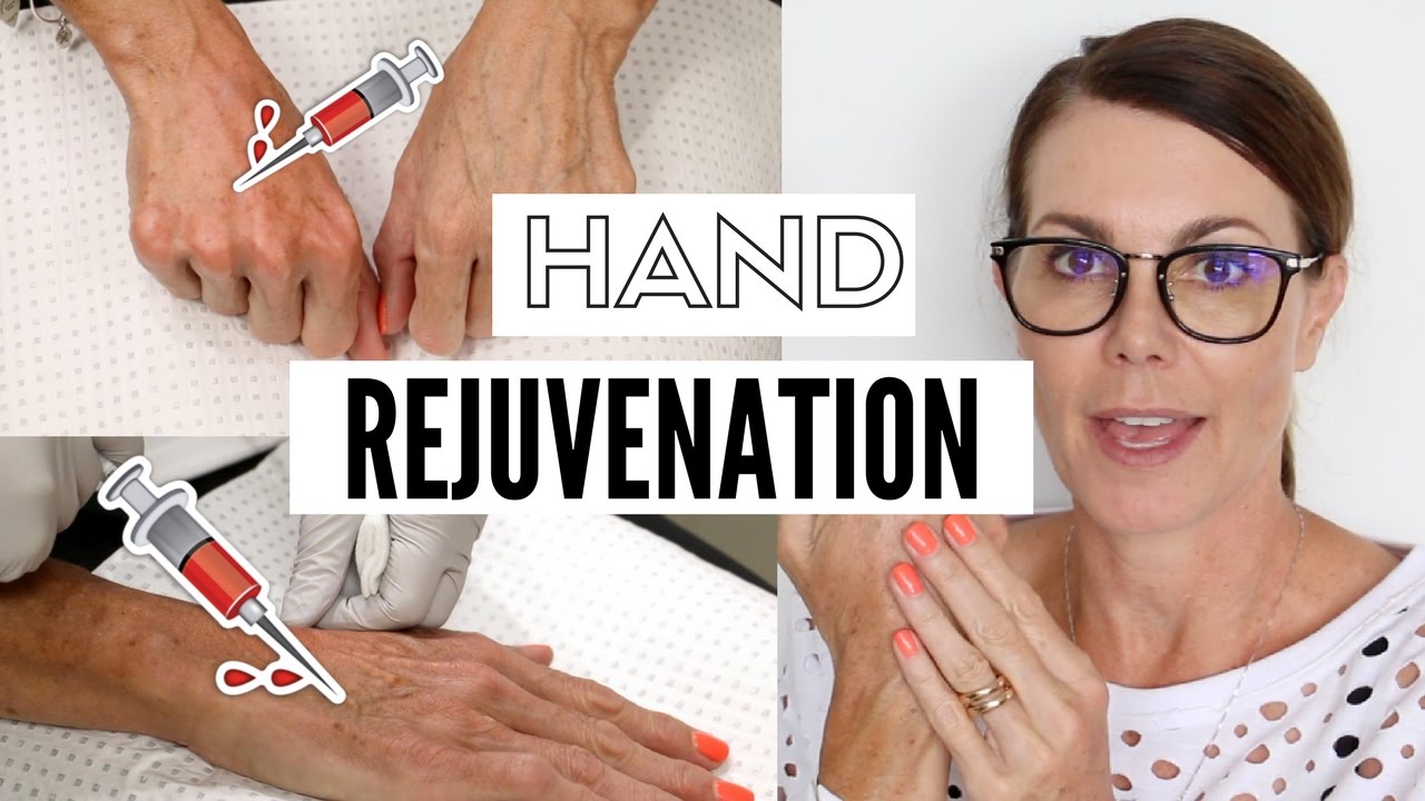 Hand Rejuvenation - Before & After