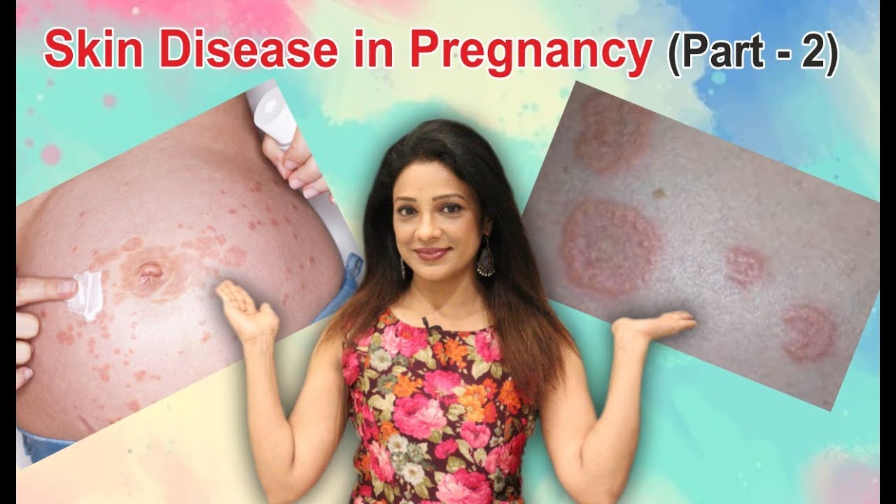 Pregnancy में अगर skin की बीमारी हो जाये तो बच्चे को नुक्सान होता है?