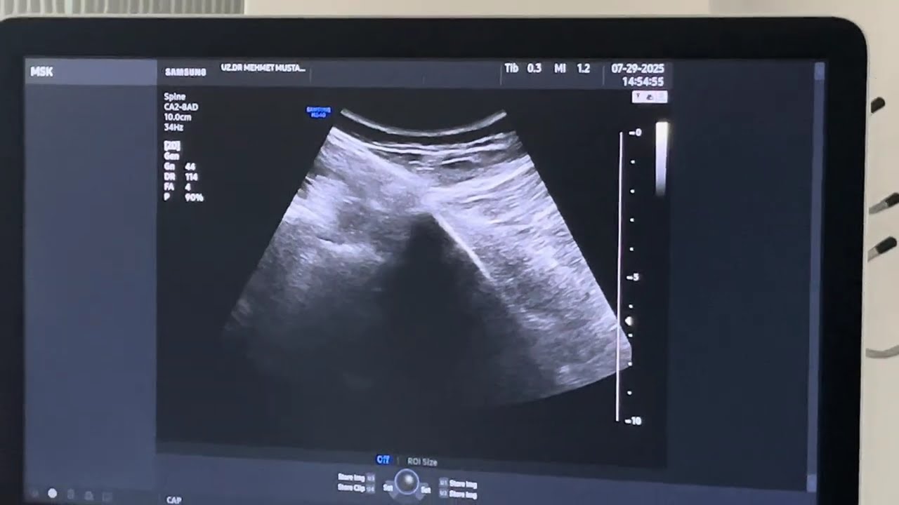 Ultrasonund Guided Low Back Pain Prolotherapy