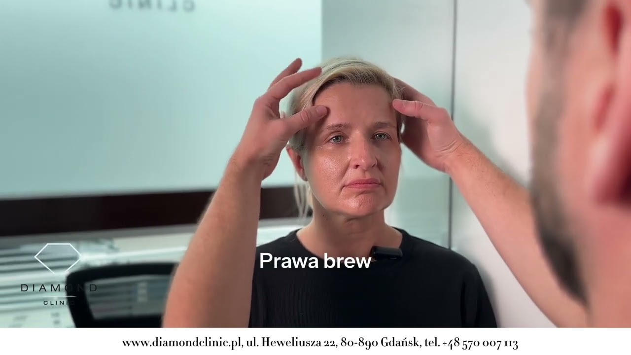 Zobaczcie kolejny etap metamorfozy Eweliny - lifting czoła w wykonaniu dr Pawła Płosaja