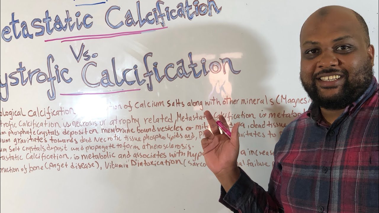 التكلس الانبثاثي و التكلس الضموري Dystrophic Calcification and Metastatic Calcification