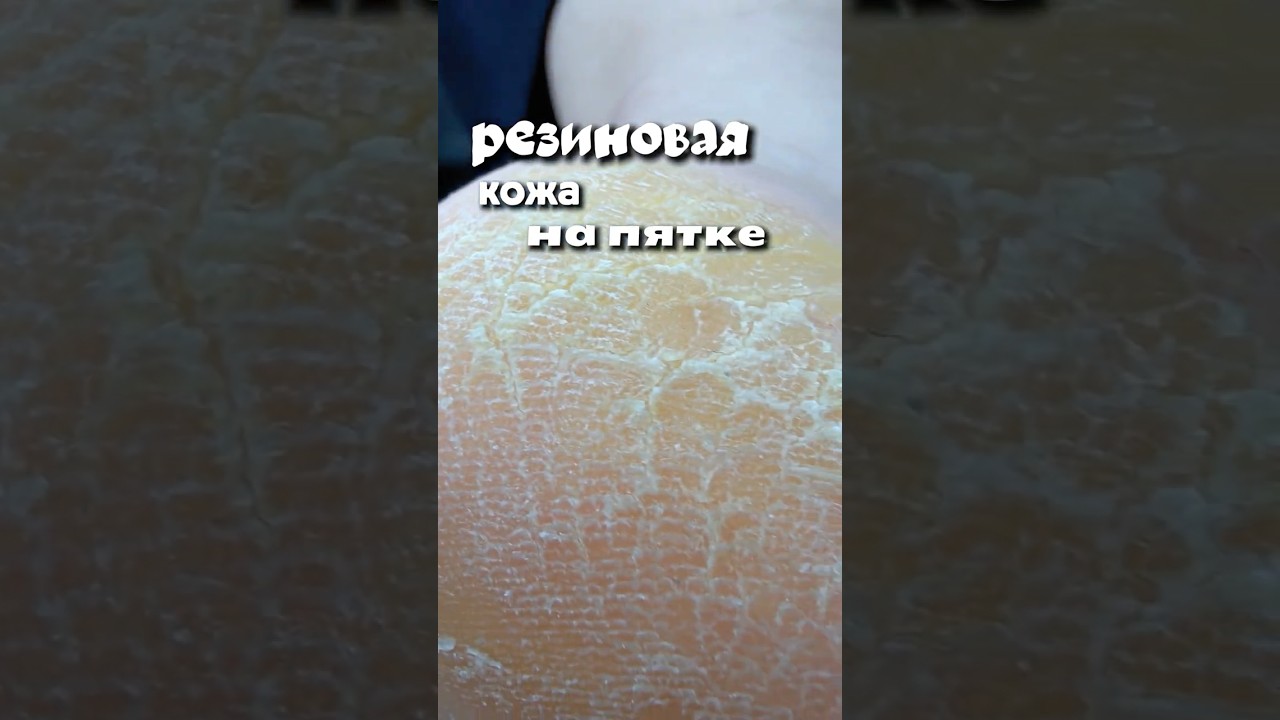 РЕЗИНОВАЯ кожа на пятке