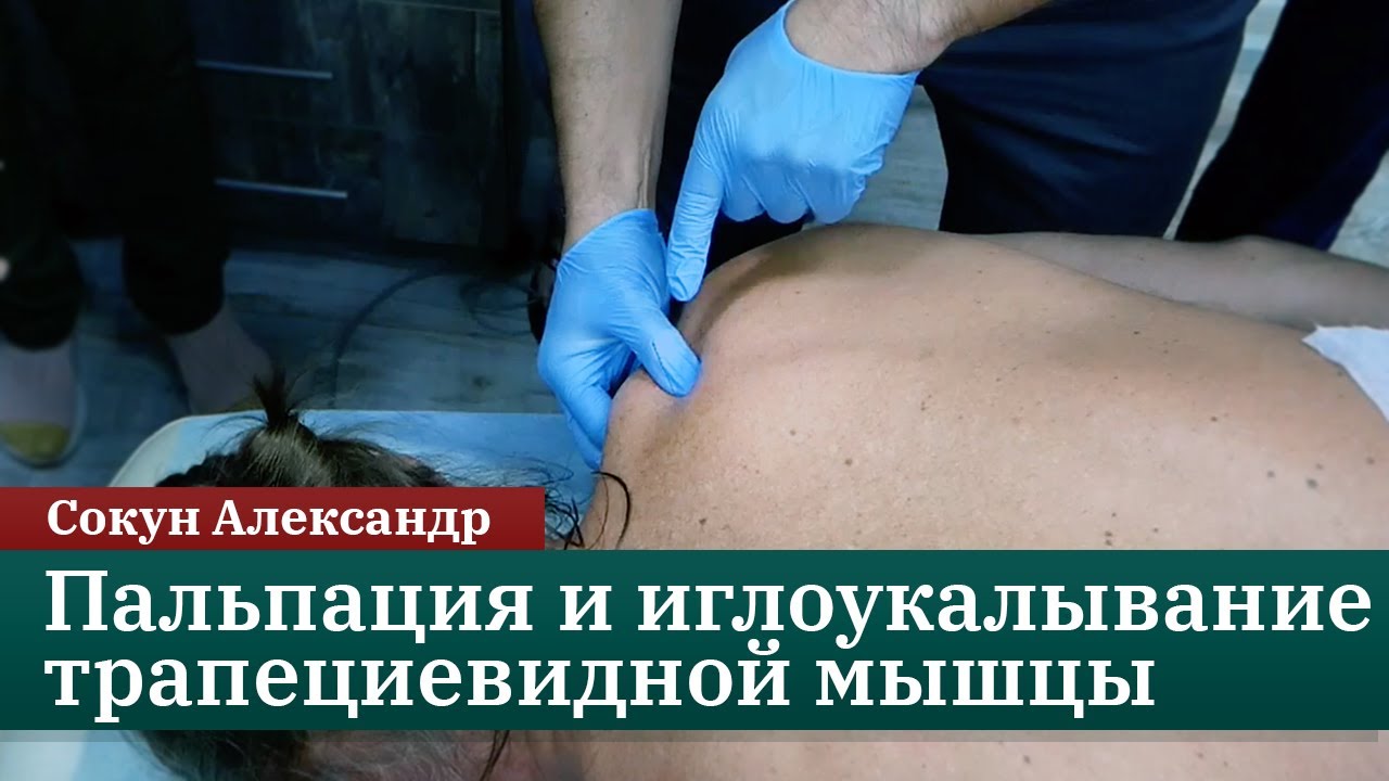 Техника пальпации и иглоукалывания трапециевидной мышцы. Сокун А.А.