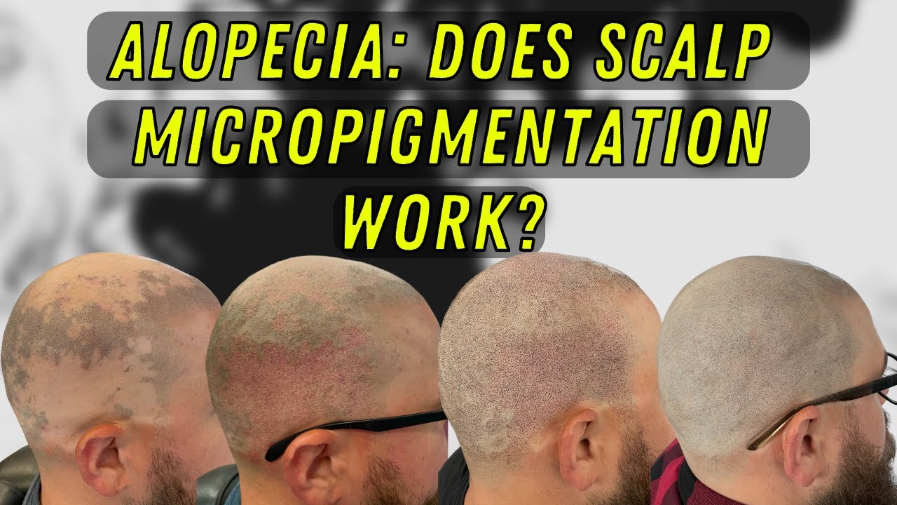 Alopecia Treatment : Does Scalp Micropigmentation Work? | Client Testimonial | TOPLINESMP