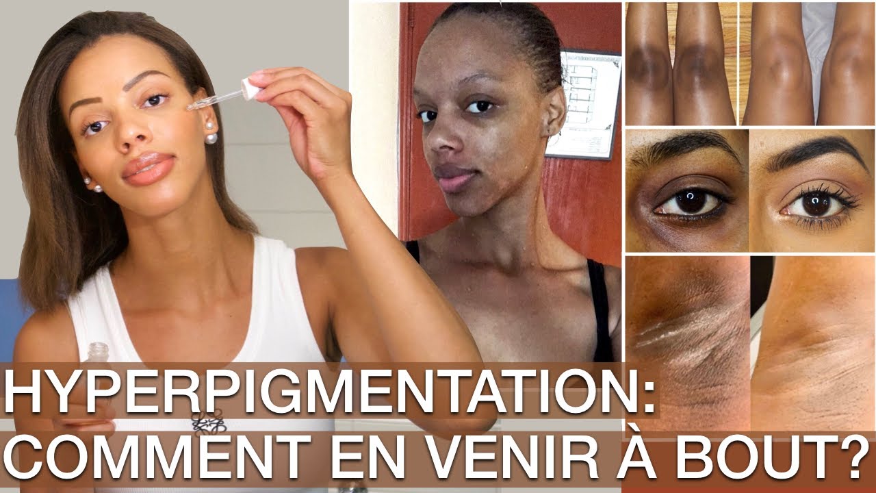 Hyperpigmentation: Conseils & Ma Routine Pour s'en débarrasser !