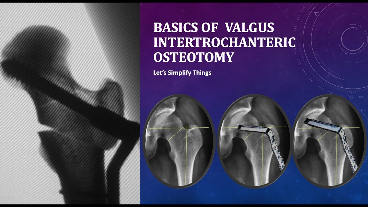 Basics of Valgus Intertrochanteric Osteotomy for Hip Fractures: Simplified